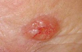 Skin Cancer Excision
